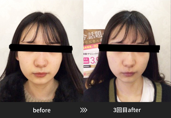 ビフォーアフター